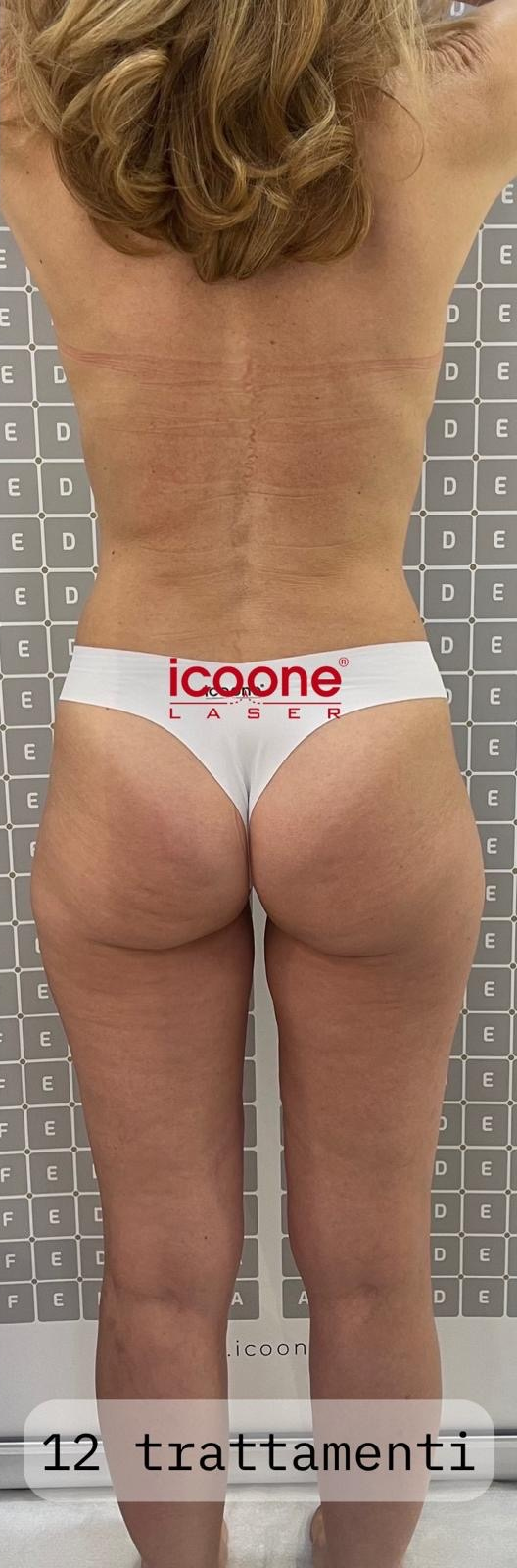 ICOONE® — Corpo — Dopo · 12 sedute